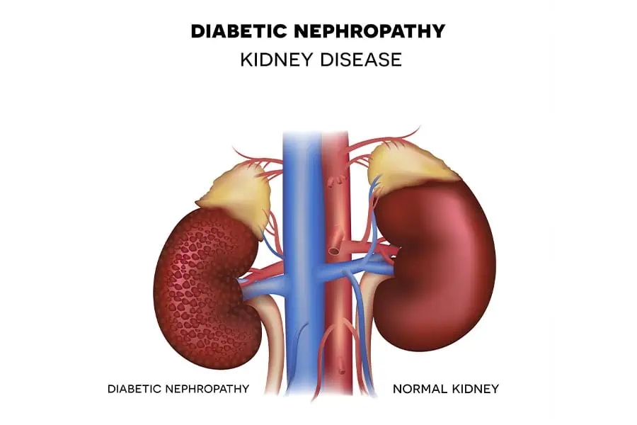 Diabetic Nephropathy Stage III