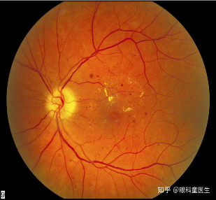 Proliferative Retinopathy