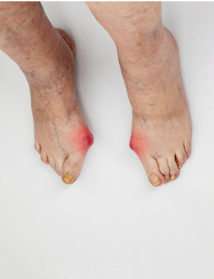Diabetic Foot Treatment