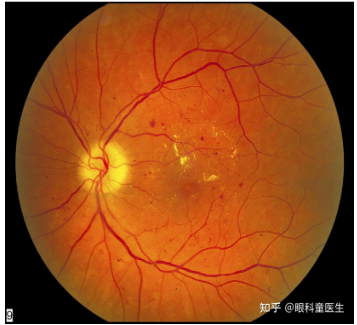 Diabetic Retinopathy