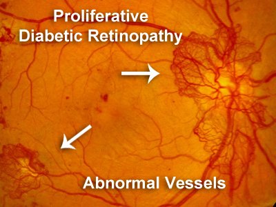 Proliferative Retinopathy